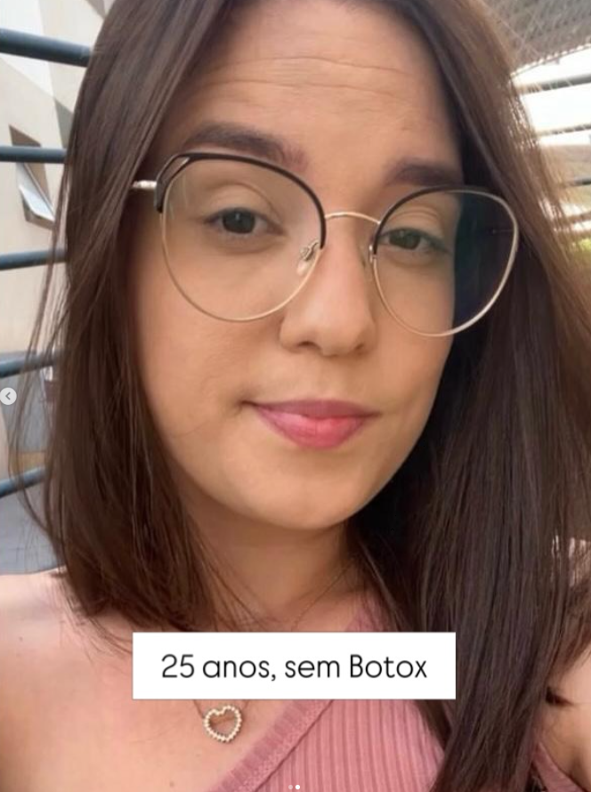 Carla aos 25 anos, sem Botox